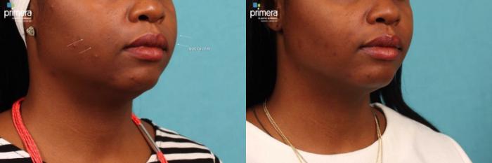 Before & After Neck & Face Liposuction Case 393 view-2 View in Orlando, Florida