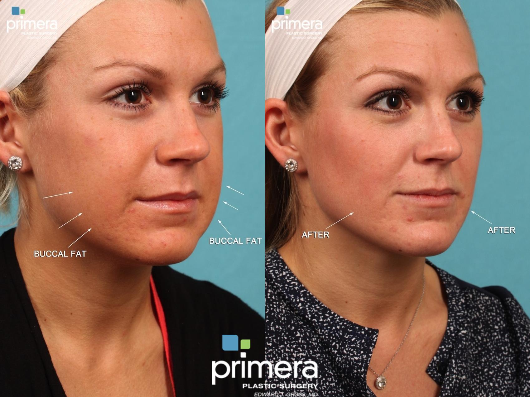 Buccal Fat Removal for Orlando & Winter Park, FL