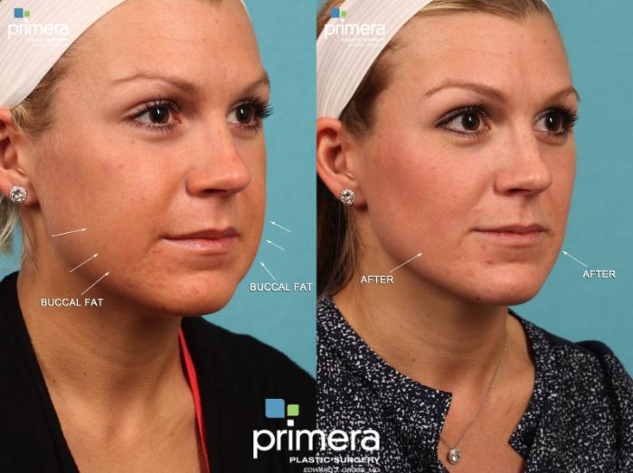 Before & After Buccal Fat Removal Case 397 view-1 View in Orlando, Florida