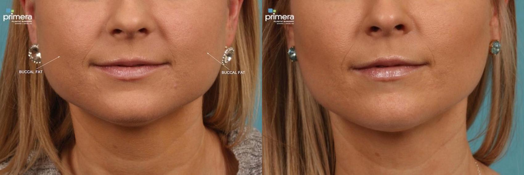 Chin Implant with Buccal Fat Pad Removal - Carolina Facial Plastics