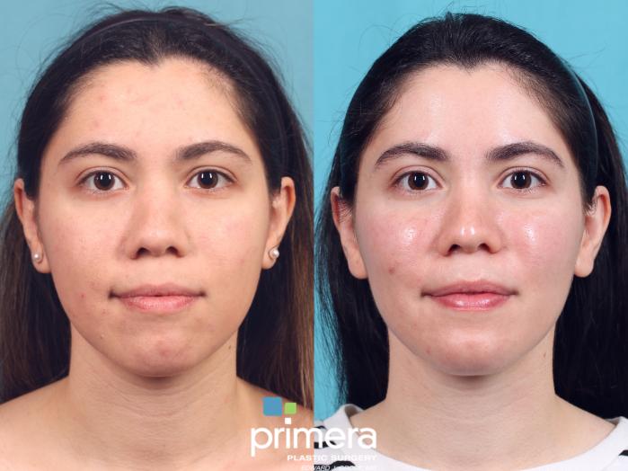 Before & After Buccal Fat Removal Case 598 Front View in Orlando, Florida