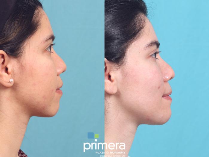 Before & After Buccal Fat Removal Case 598 Right Side View in Orlando, Florida