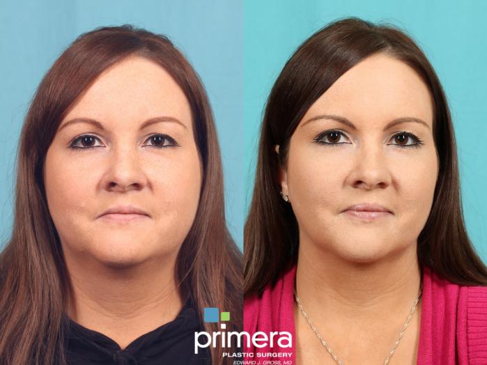 Before & After Neck & Face Liposuction Case 599 Front View in Orlando, Florida