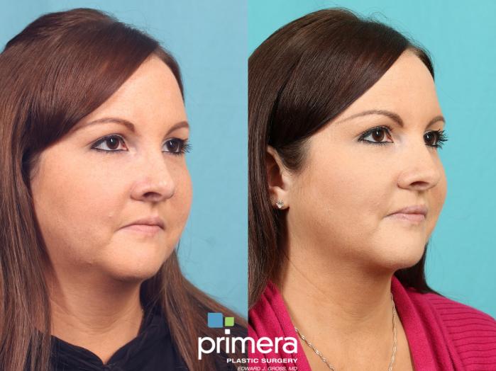 Before & After Neck & Face Liposuction Case 599 Right Oblique View in Orlando, Florida