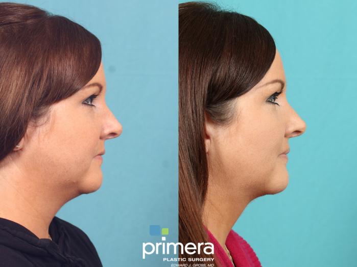 Before & After Buccal Fat Removal Case 599 Right Side View in Orlando, Florida