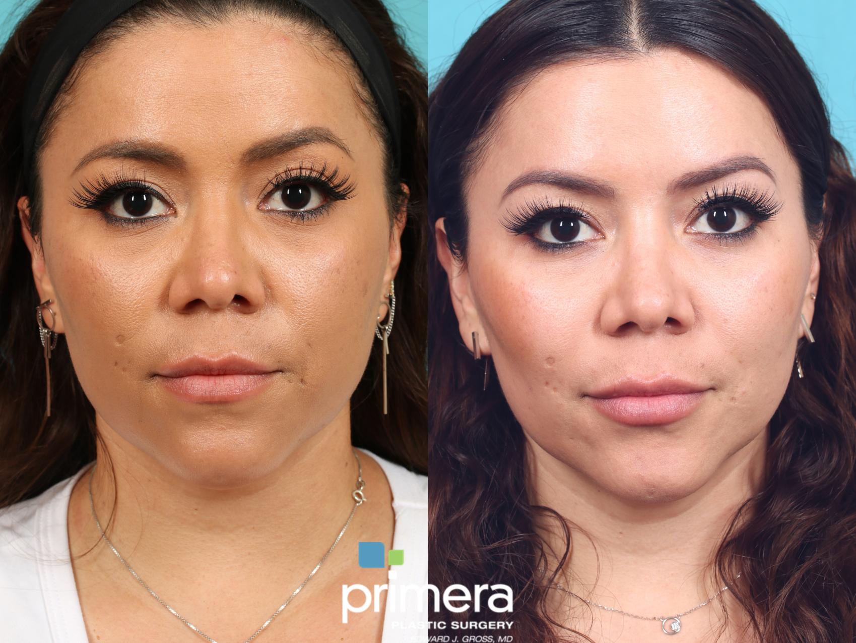 Buccal Fat Removal Before And After Pictures Case 615 Orlando
