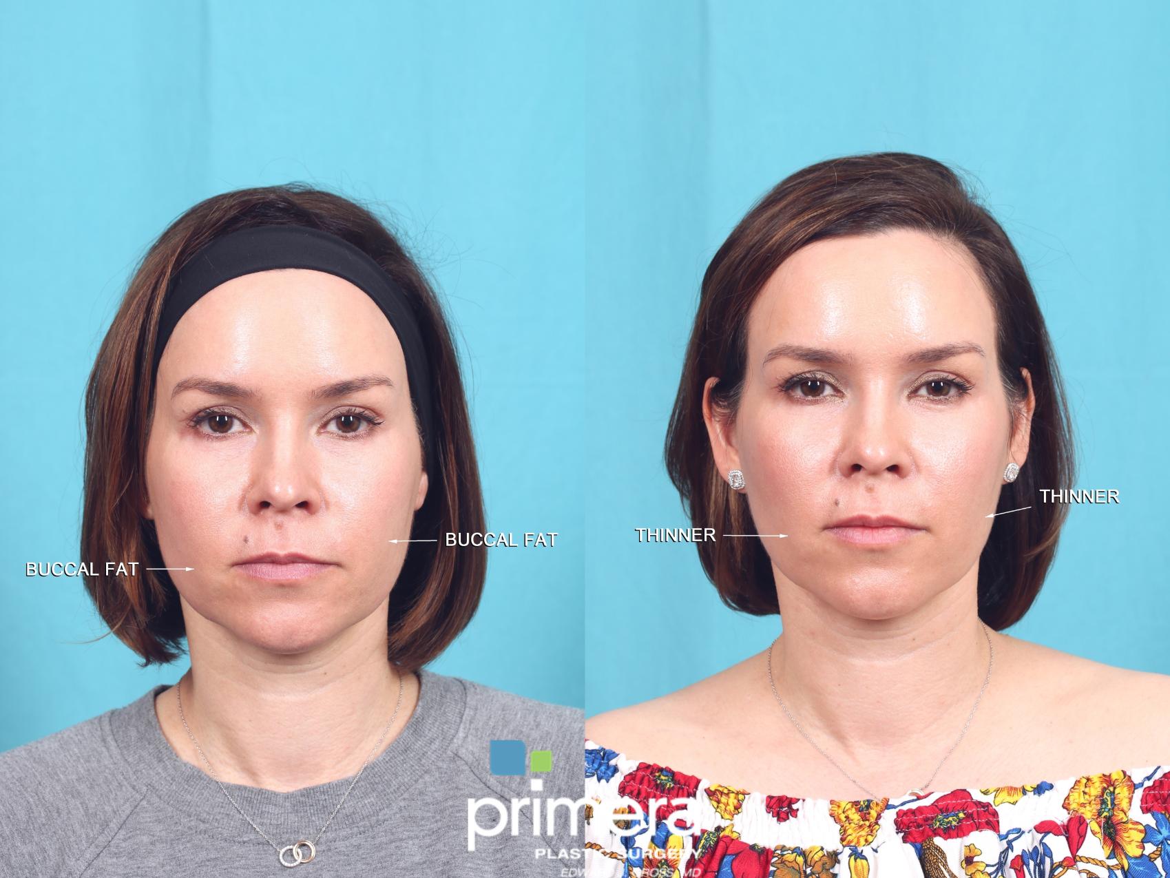 BUCCAL FAT REMOVAL | CHEEKS | ORLANDO