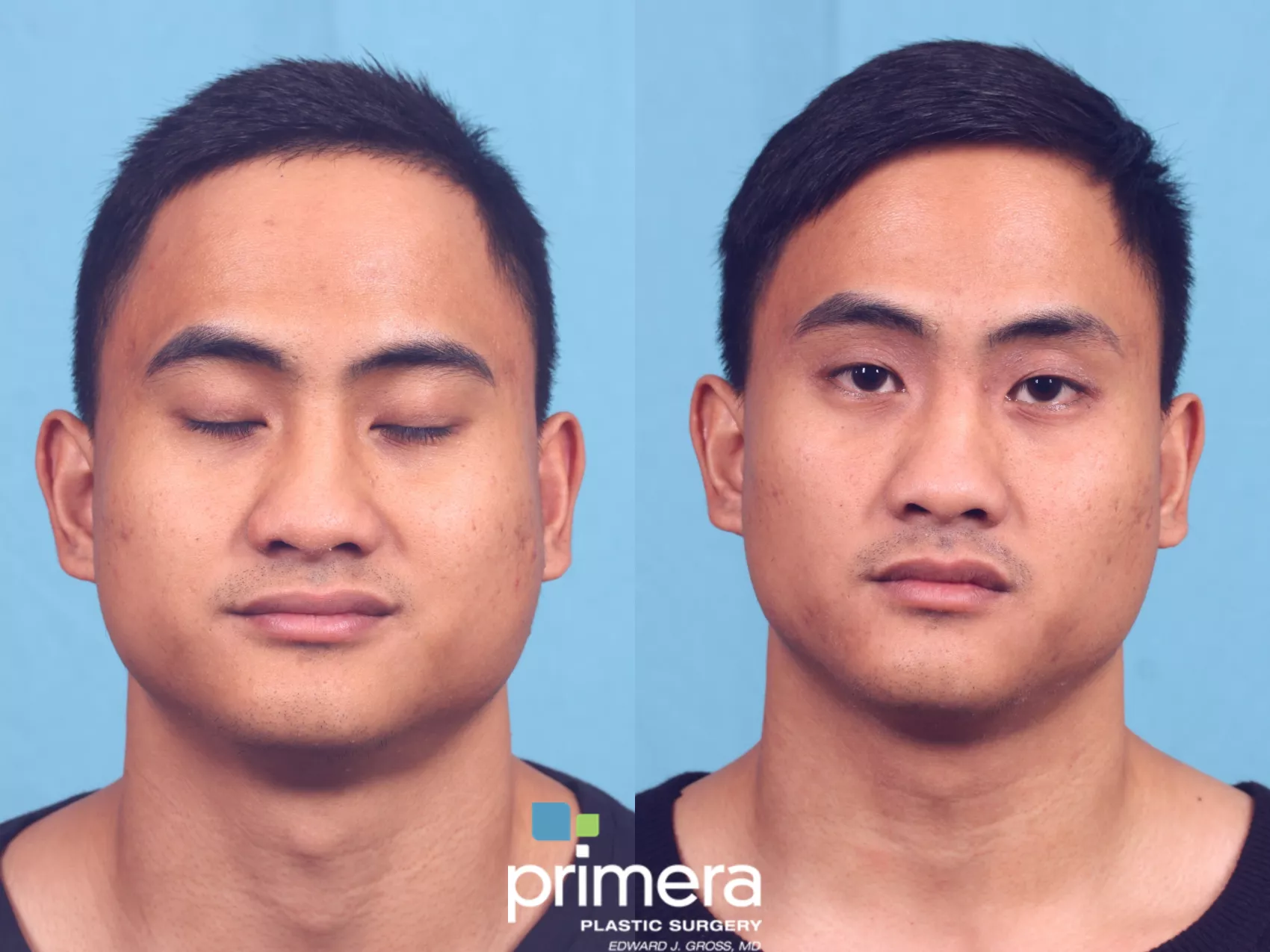 Buccal Fat Removal Before and After Pictures Case 675 | Orlando, Florida |  Primera Plastic Surgery