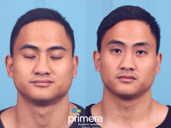 Before & After Buccal Fat Removal Case 675 Front View in Orlando, Florida