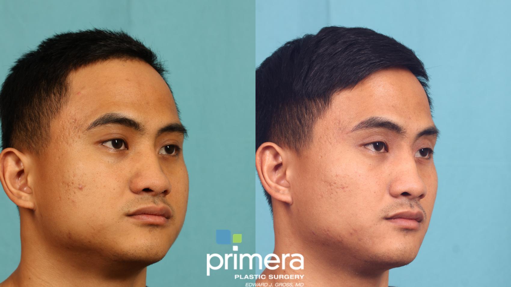 Before & After Buccal Fat Removal Case 752 Right Oblique View in Orlando, Florida