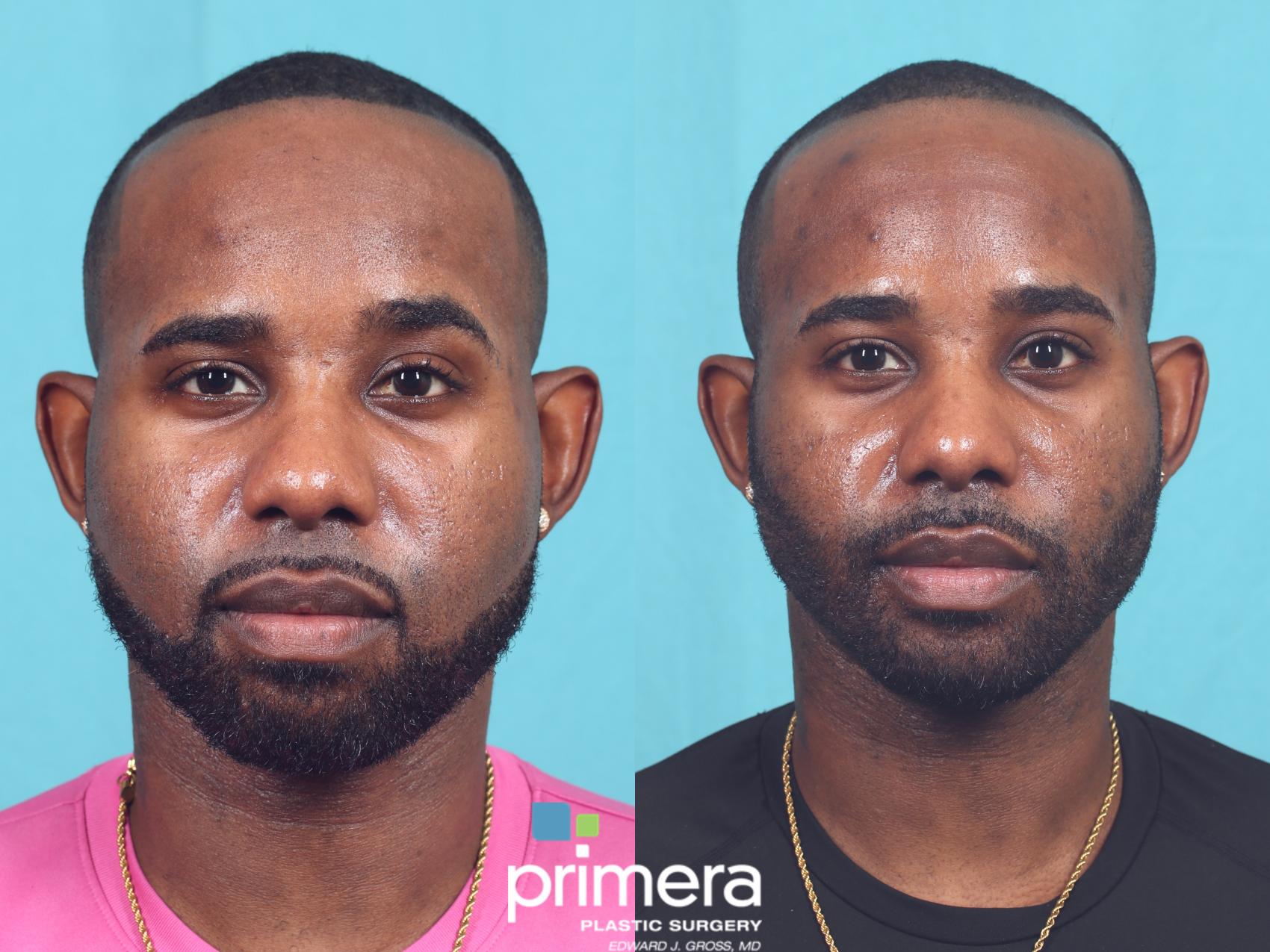 Before & After Buccal Fat Removal Case 826 Front View in Orlando, Florida