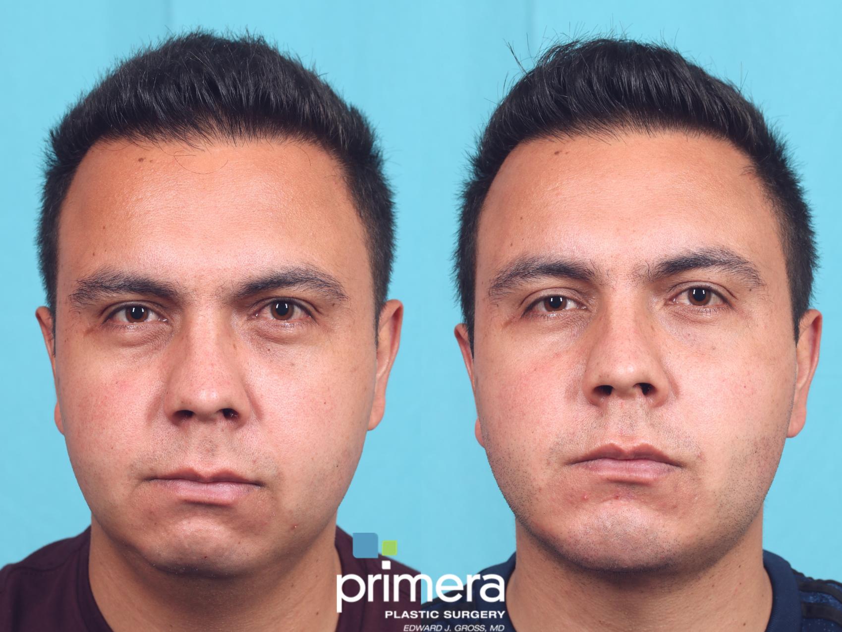 Before & After Buccal Fat Removal Case 827 Front View in Orlando, Florida