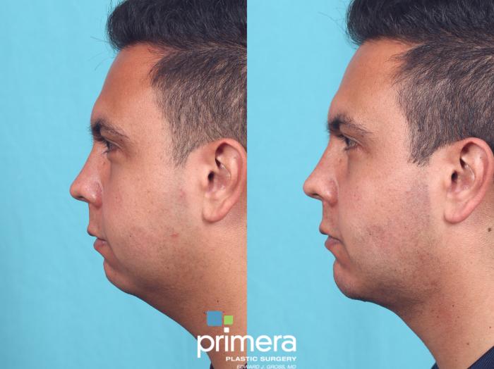 Before & After Buccal Fat Removal Case 827 Left Side View in Orlando, Florida
