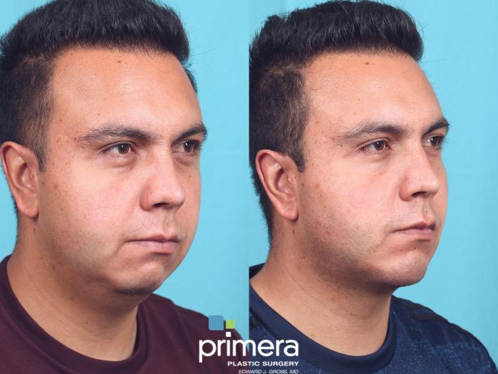 Before & After Chin & Cheek Implant Case 827 Right Oblique View in Orlando, Florida