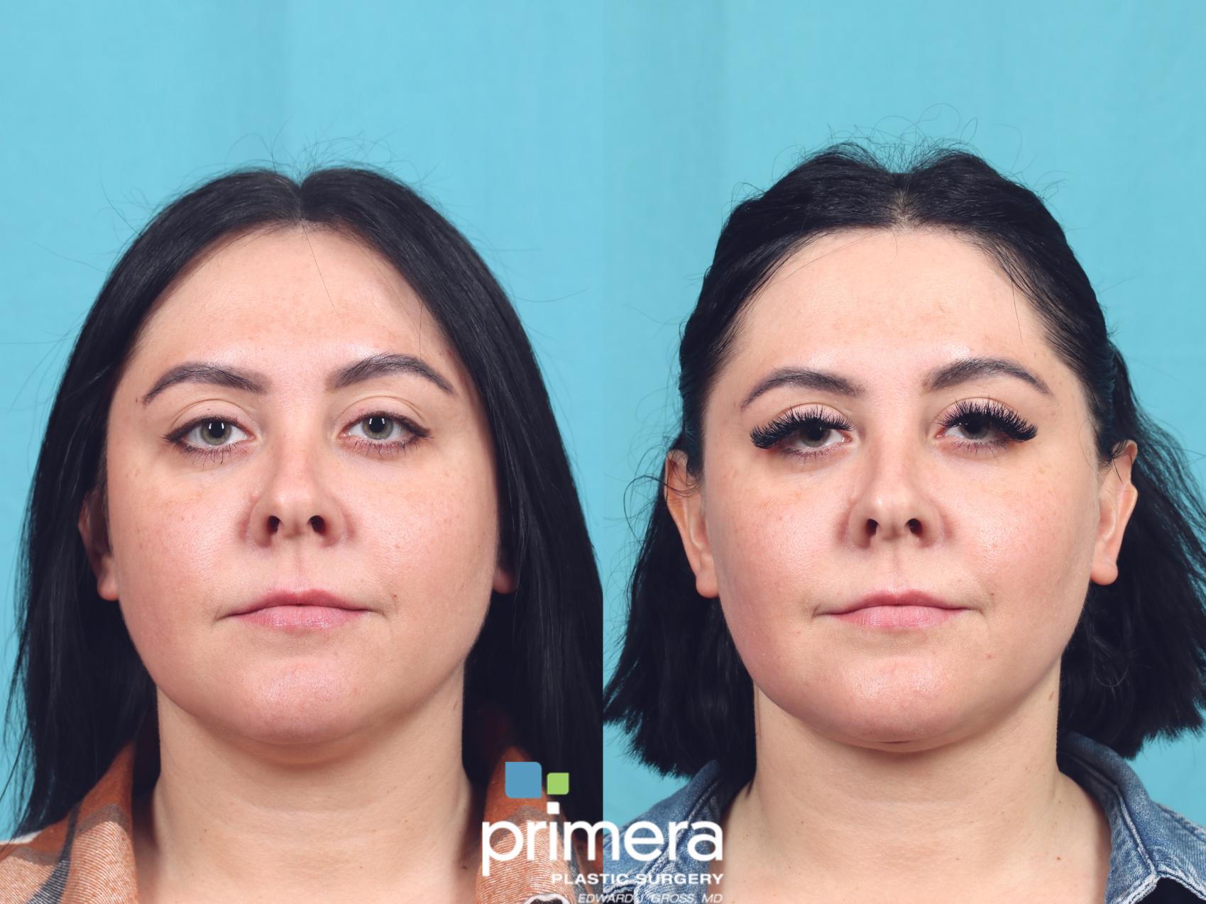 Before & After Neck & Face Liposuction Case 830 Front View in Orlando, Florida