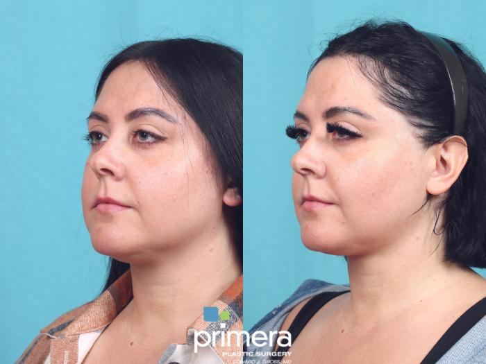 Before & After Buccal Fat Removal Case 830 Left Oblique View in Orlando, Florida