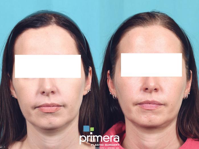 Before & After Buccal Fat Removal Case 847 Front View in Orlando, Florida