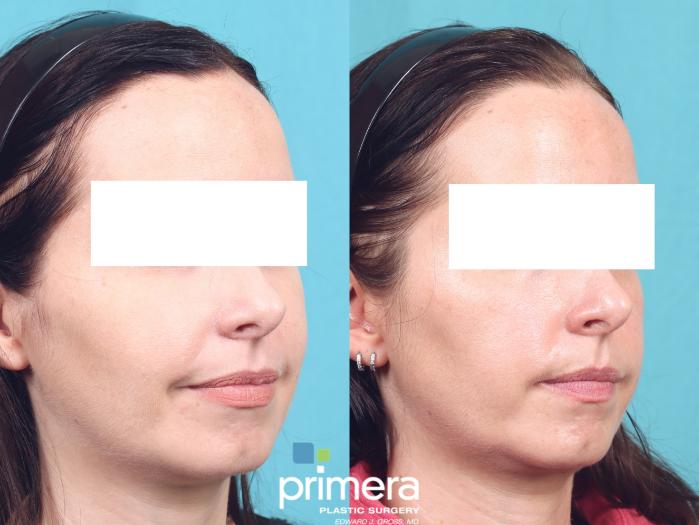 Before & After Buccal Fat Removal Case 847 Right Oblique View in Orlando, Florida