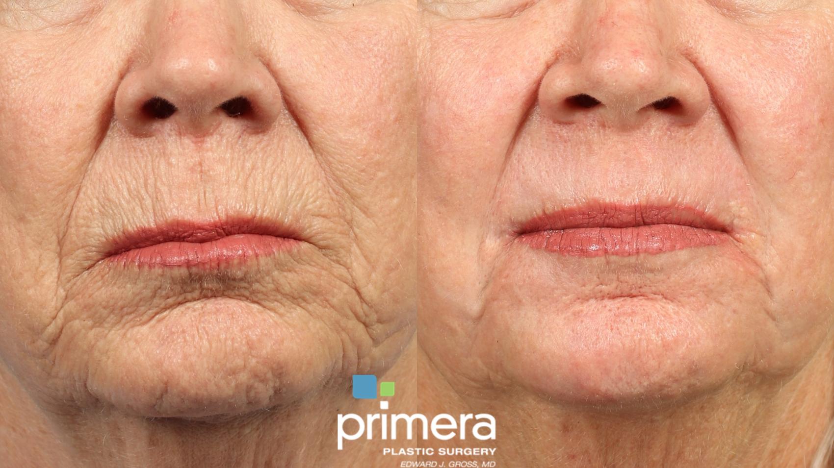 Before & After Chemical Peel Case 1031 Front View in Orlando, Winter Park & Tampa, Florida