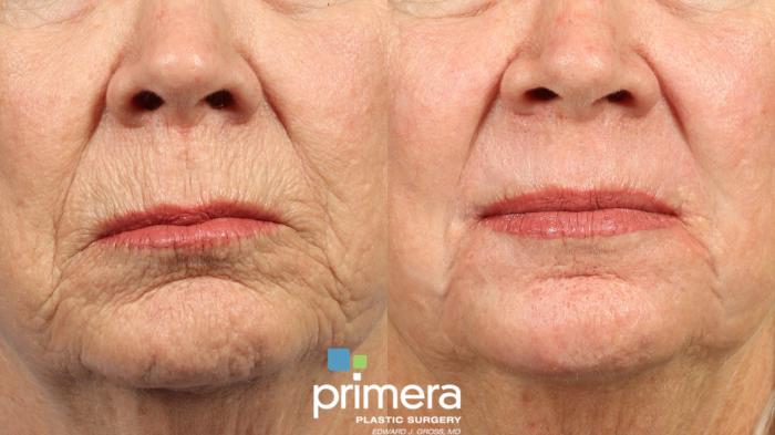 Before & After Chemical Peel Case 1031 Front View in Orlando, Winter Park & Tampa, Florida