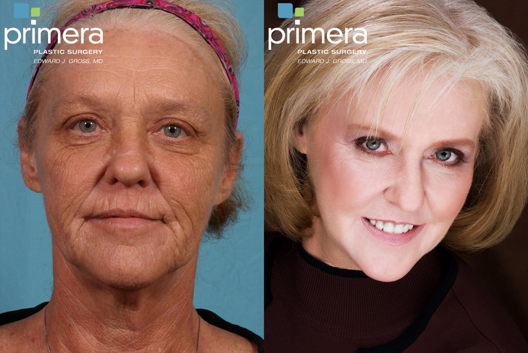 Chemical Peel Before And After Photos Patient 107 Orlando Florida