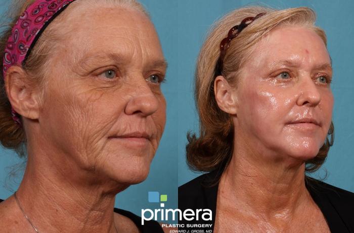 Chemical Peel Before And After Pictures Case 197 Orlando Florida
