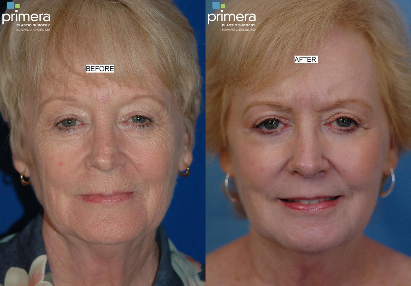 Before & After Blepharoplasty Case 78 view-1 View in Orlando, Florida