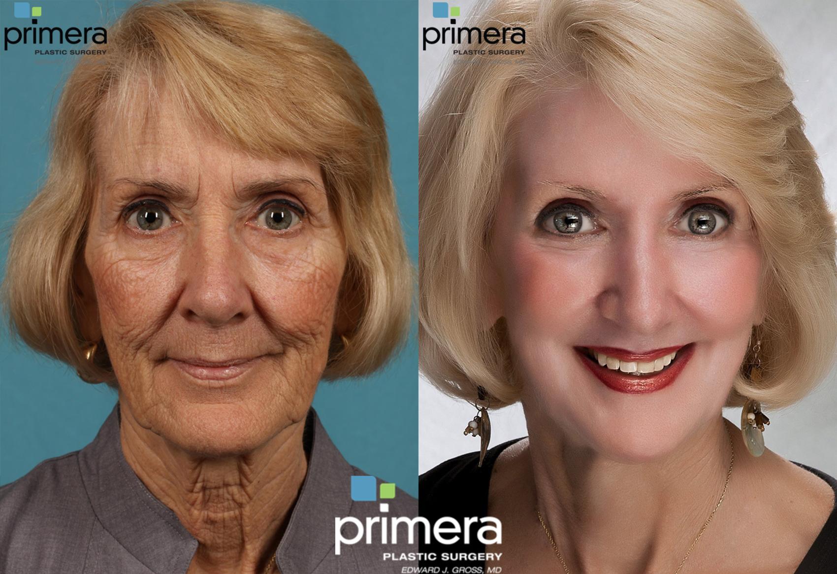 Chemical Peel Before And After Photo Gallery Orlando Florida Primera Plastic Surgery