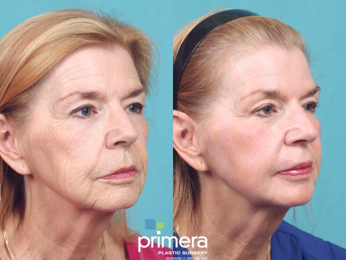 Before & After Chemical Peel Case 989 Right Oblique View in Orlando, Florida