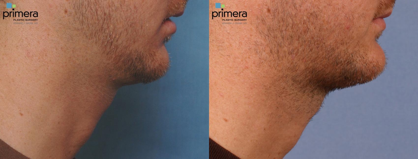 Before & After Chin & Cheek Implant Case 101 view-1 View in Orlando, Florida