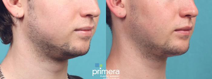 Before & After Chin & Cheek Implant Case 1032 Right Oblique View in Orlando, Winter Park & Tampa, Florida