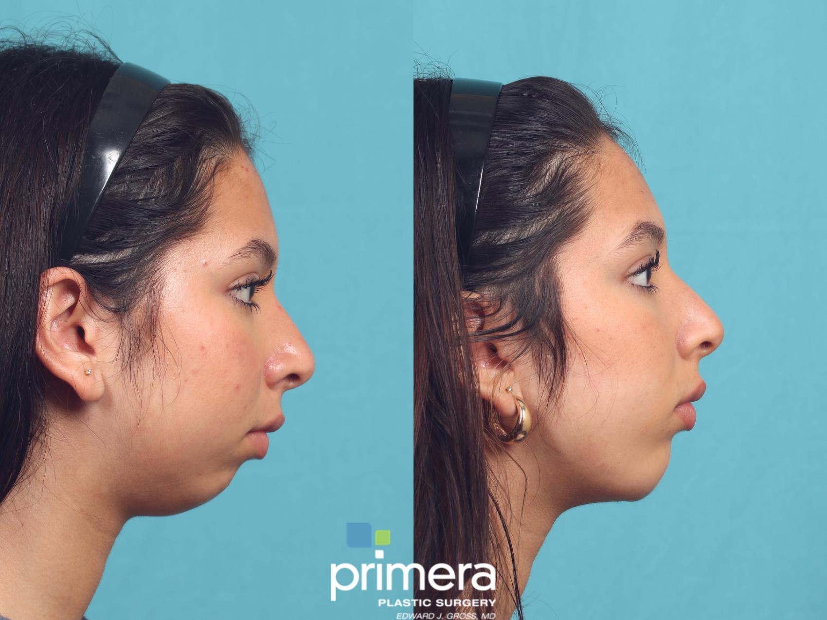 Before & After Chin & Cheek Implant Case 1036 Right Side View in Orlando, Winter Park & Tampa, Florida
