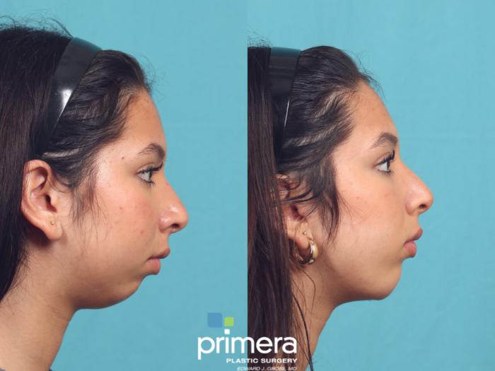 Before & After Chin & Cheek Implant Case 1036 Right Side View in Orlando, Winter Park & Tampa, Florida