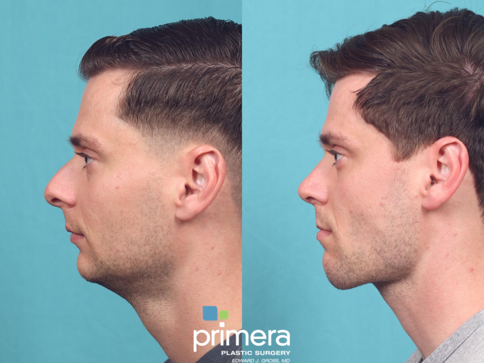 Before & After Submentoplasty (Chin Tuck) Case 1055 Left Side View in Orlando, Winter Park & Tampa, Florida