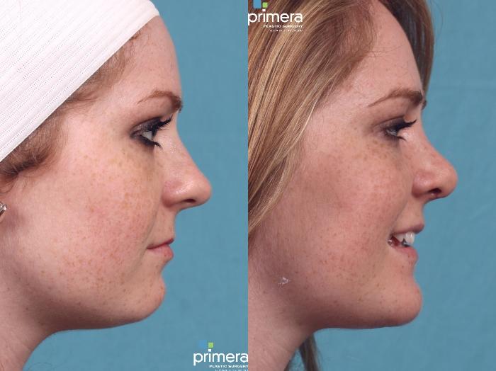 Before & After Chin & Cheek Implant Case 292 view-1 View in Orlando, Florida