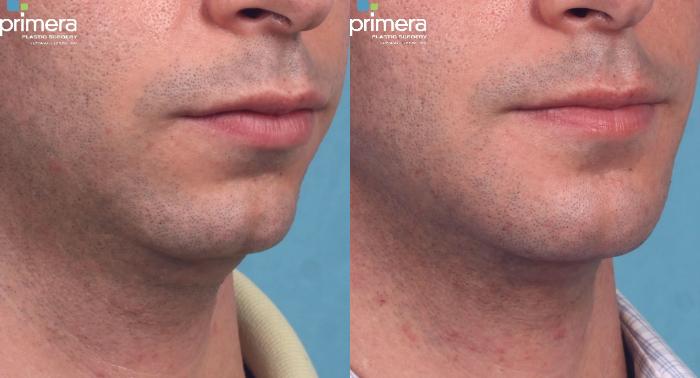 Before & After Chin & Cheek Implant Case 296 view-1 View in Orlando, Florida