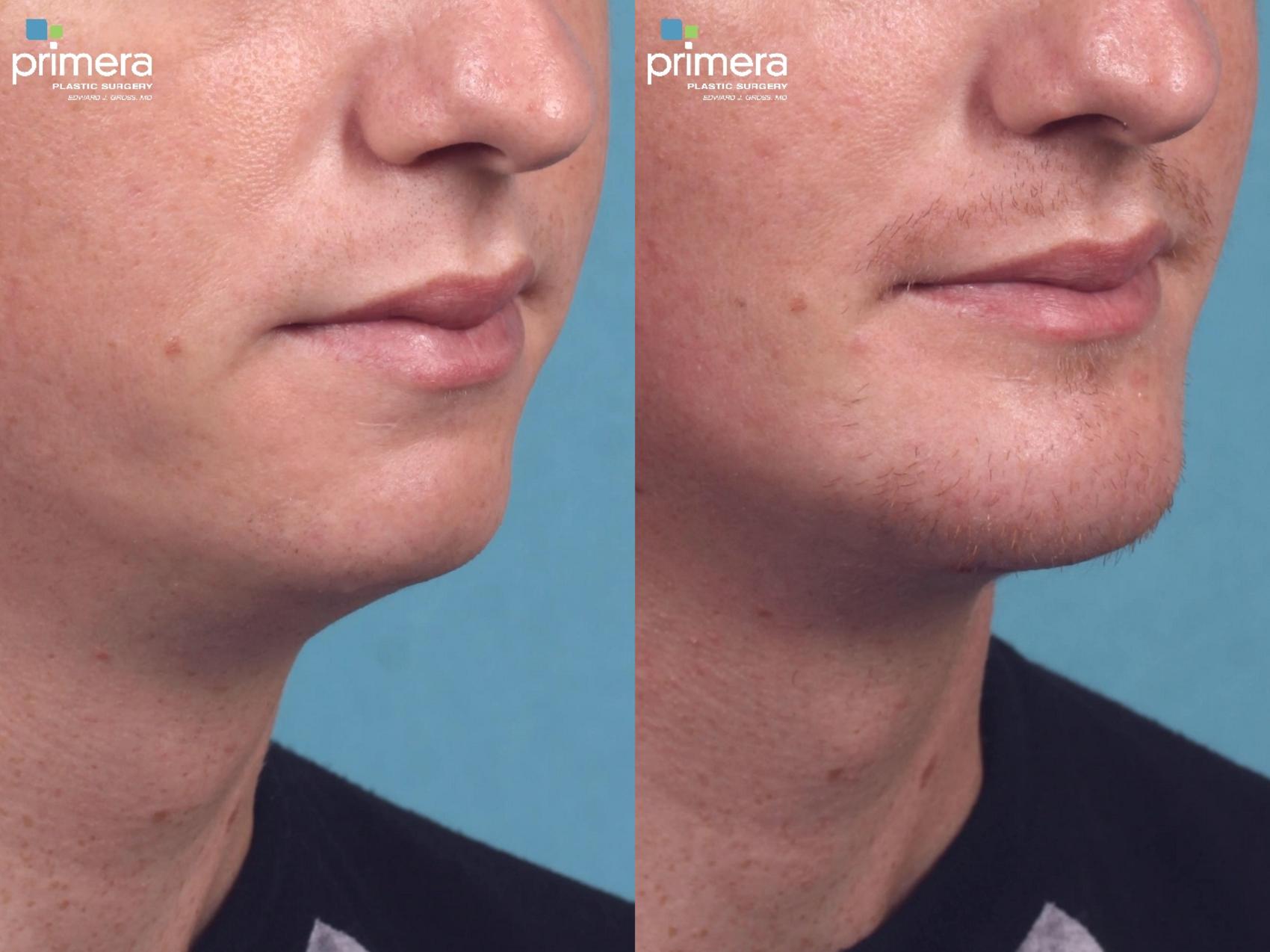 Before & After Chin & Cheek Implant Case 345 view-1 View in Orlando, Florida