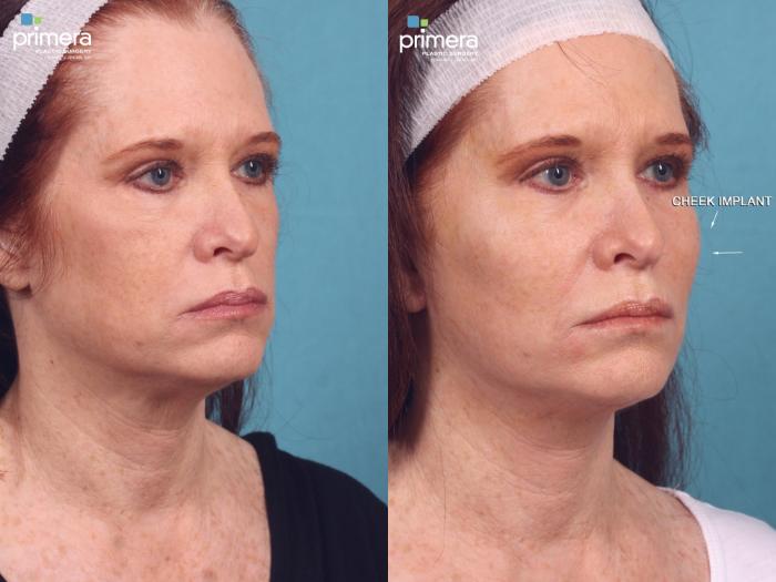 Before & After Chin & Cheek Implant Case 417 view-1 View in Orlando, Florida