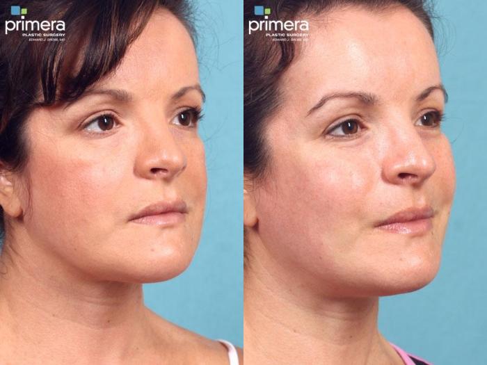 Before & After Chin & Cheek Implant Case 466 view-1 View in Orlando, Florida