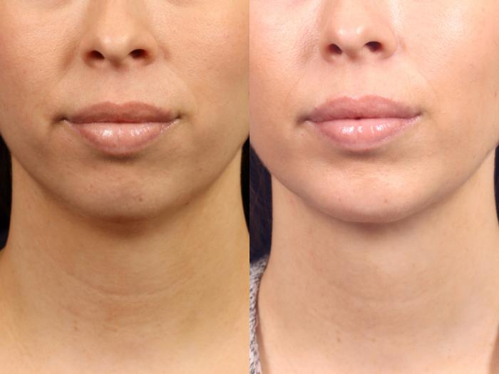 Before & After Chin & Cheek Implant Case 584 Front View in Orlando, Florida