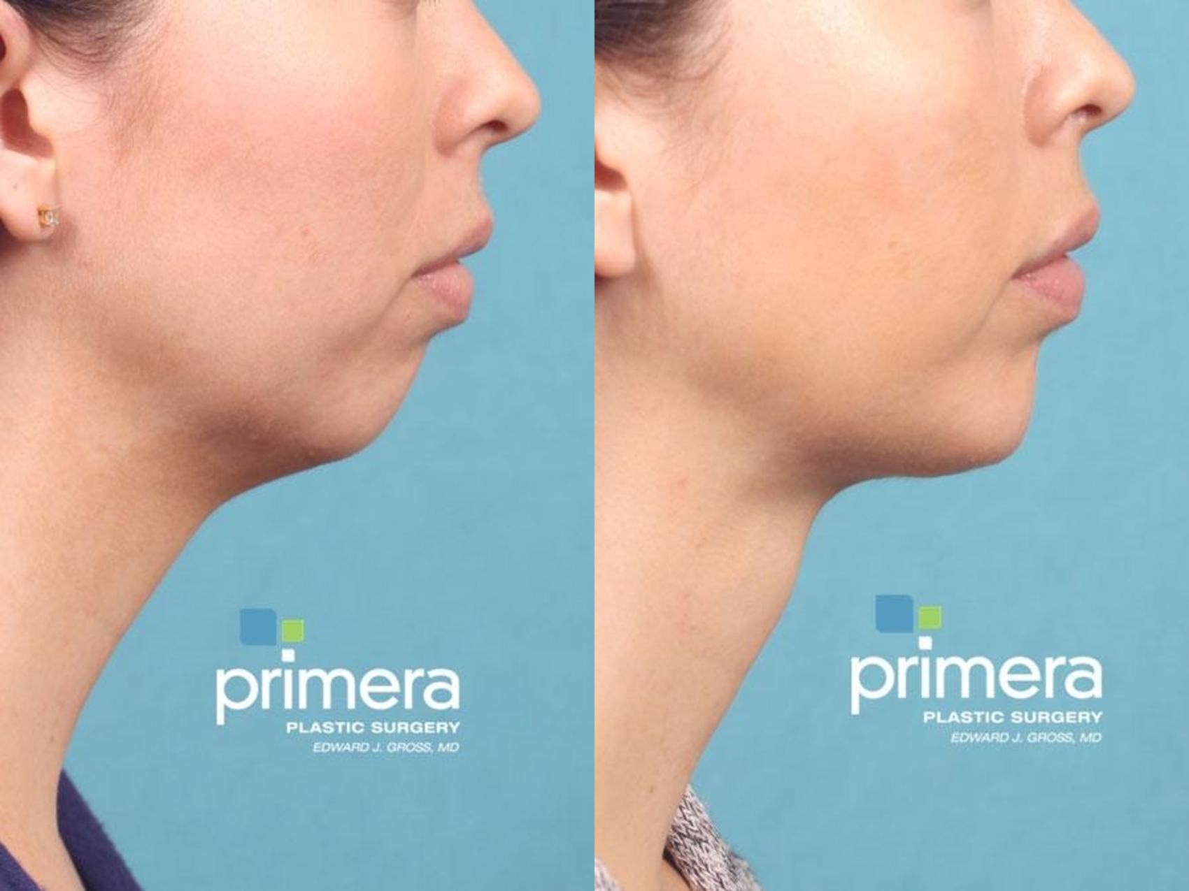 Before & After Chin & Cheek Implant Case 584 view-1 View in Orlando, Florida
