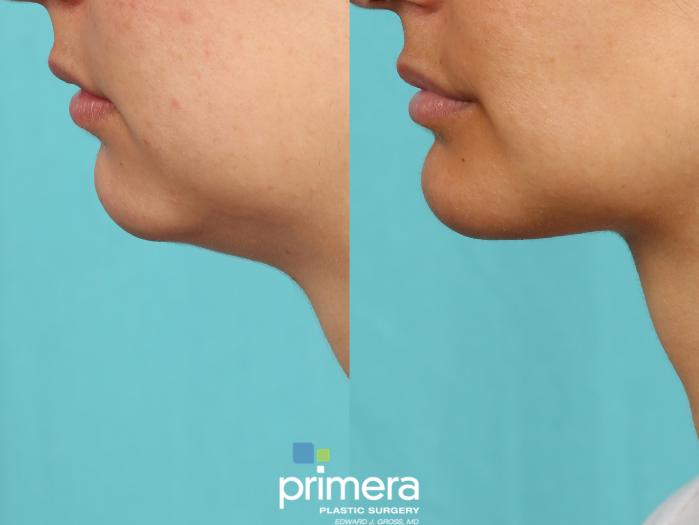 Before & After Submentoplasty (Chin Tuck) Case 614 Left Side View in Orlando, Florida