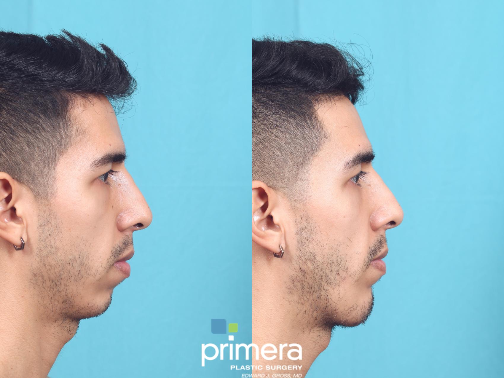 Before & After Chin & Cheek Implant Case 636 Right Side View in Orlando, Florida