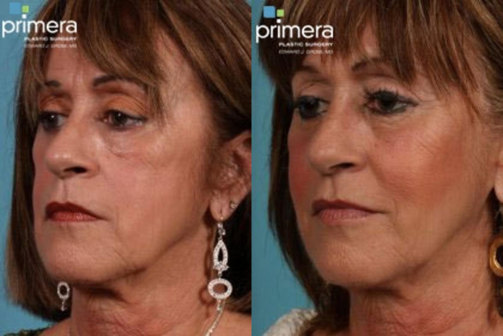 Before & After Chin & Cheek Implant Case 67 view-1 View in Orlando, Florida