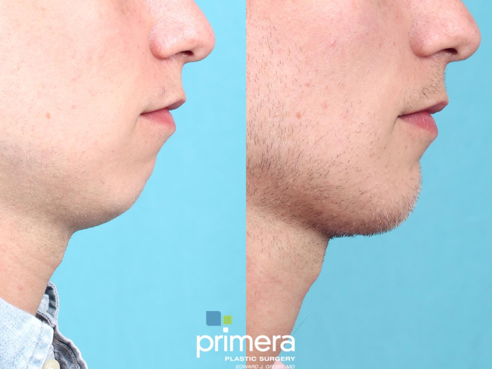 Before & After Chin & Cheek Implant Case 684 Right Side View in Orlando, Florida