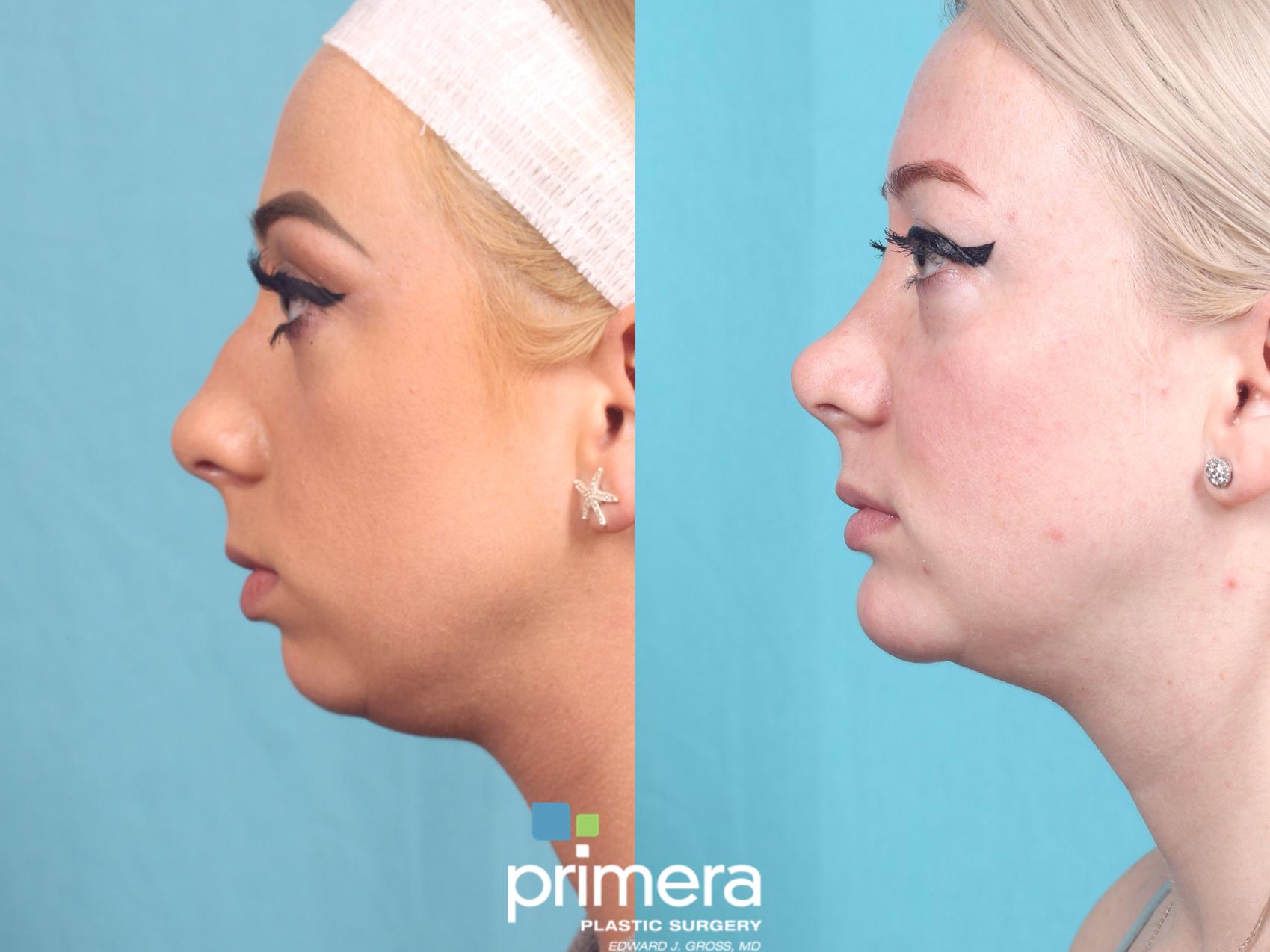 Before & After Rhinoplasty Case 753 Left Side View in Orlando, Florida