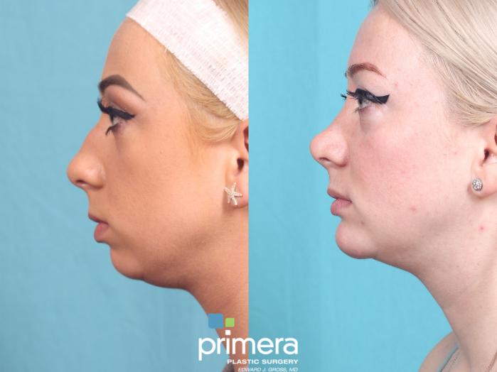 Before & After Chin & Cheek Implant Case 753 Left Side View in Orlando, Florida
