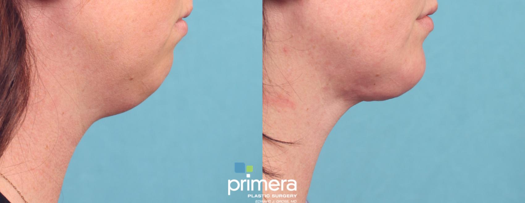 Before & After Chin & Cheek Implant Case 817 Right Side View in Orlando, Florida