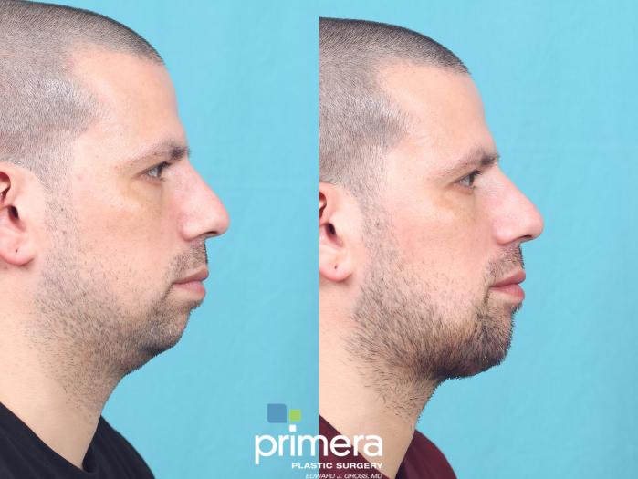 Before & After Chin & Cheek Implant Case 825 Right Side View in Orlando, Florida