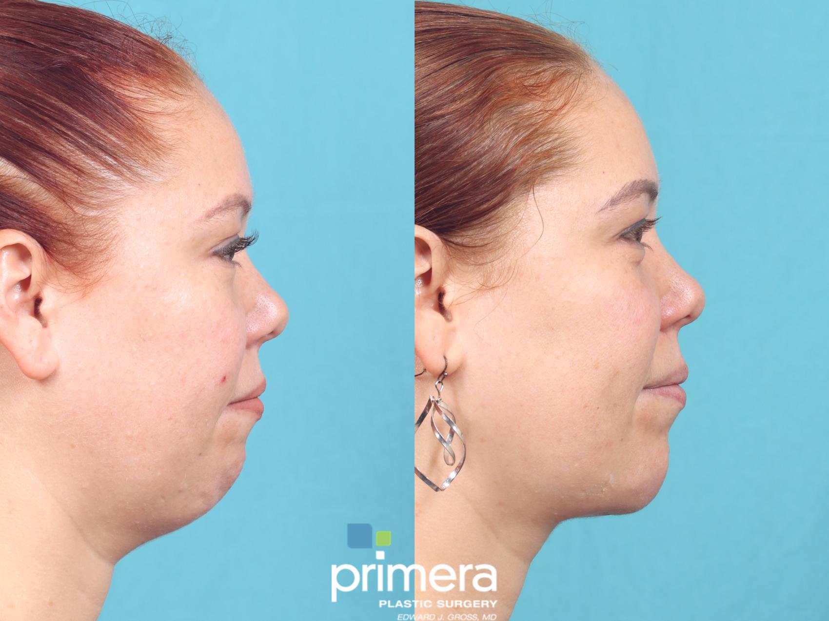 Before & After Chin & Cheek Implant Case 870 Right Side View in Orlando, Florida